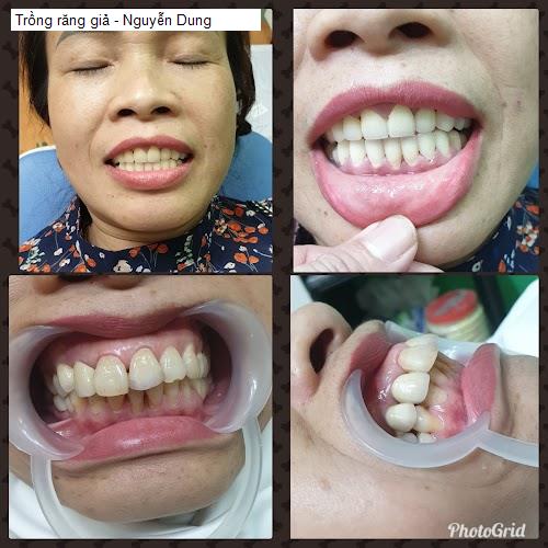 Hình ảnh Trồng răng giả - Nguyễn Dung